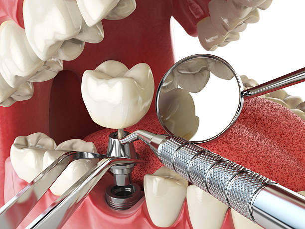 Best Emergency Treatment for Toothache in Keeseville, NY
